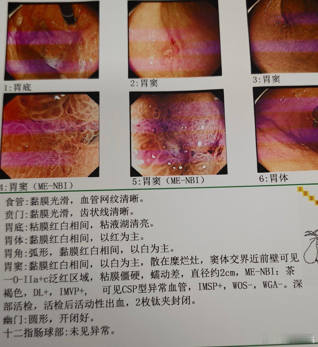 虽然，是已经发现疑似，直观看到CSP异形血管结构。早癌这块的学习，基本上在“微博