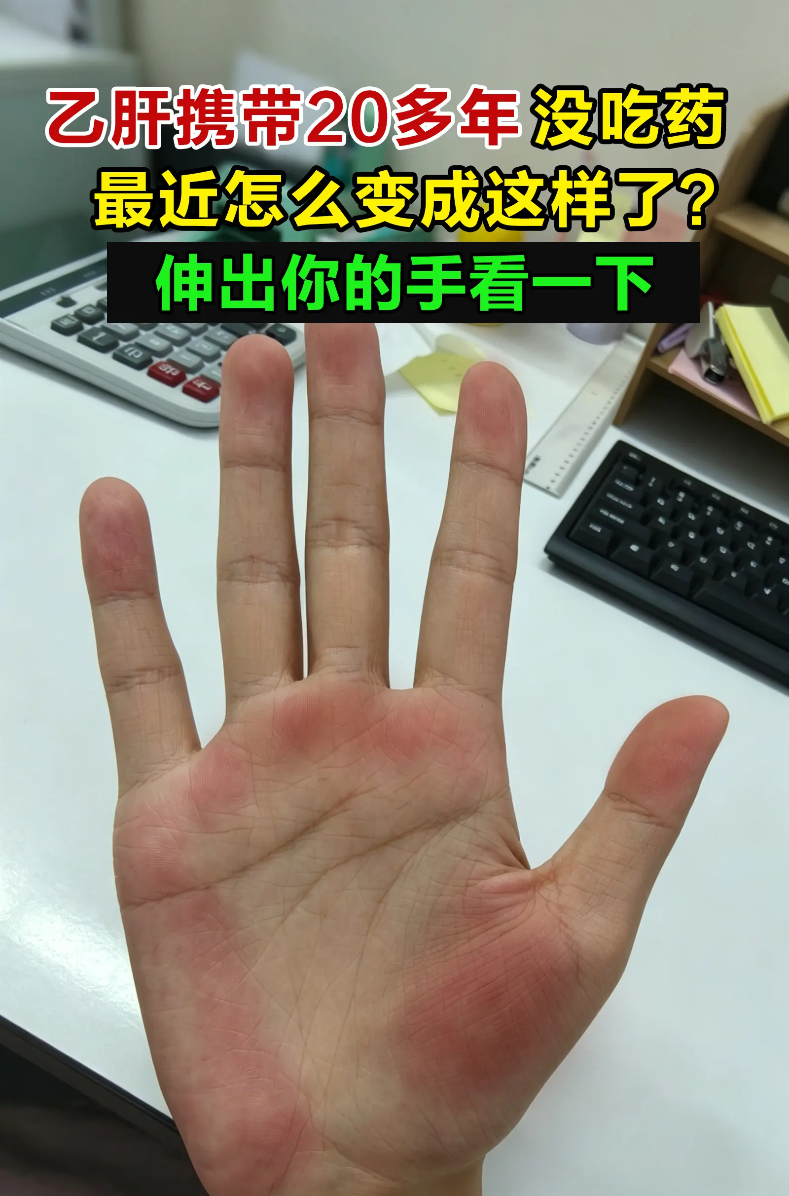 这就是肝掌。常见于乙肝、肝硬化、脂肪肝等人群。手掌大小鱼际位置发红，按...