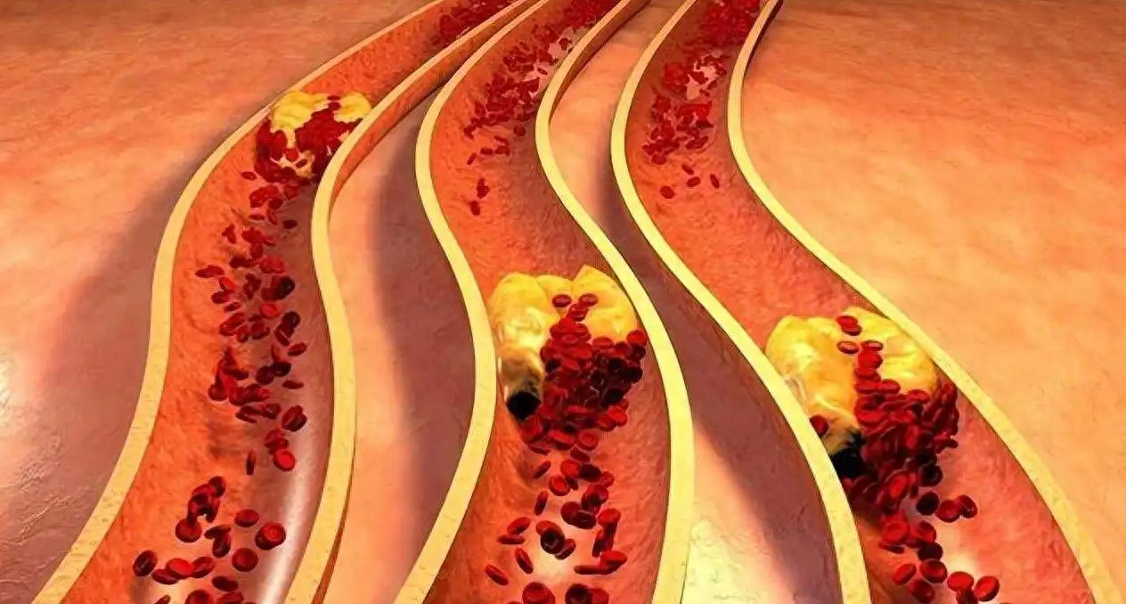 重度血瘀别瞎活血！记住顺序：泻火→活血→化瘀→补气血，才是根治之道
提示：本内容