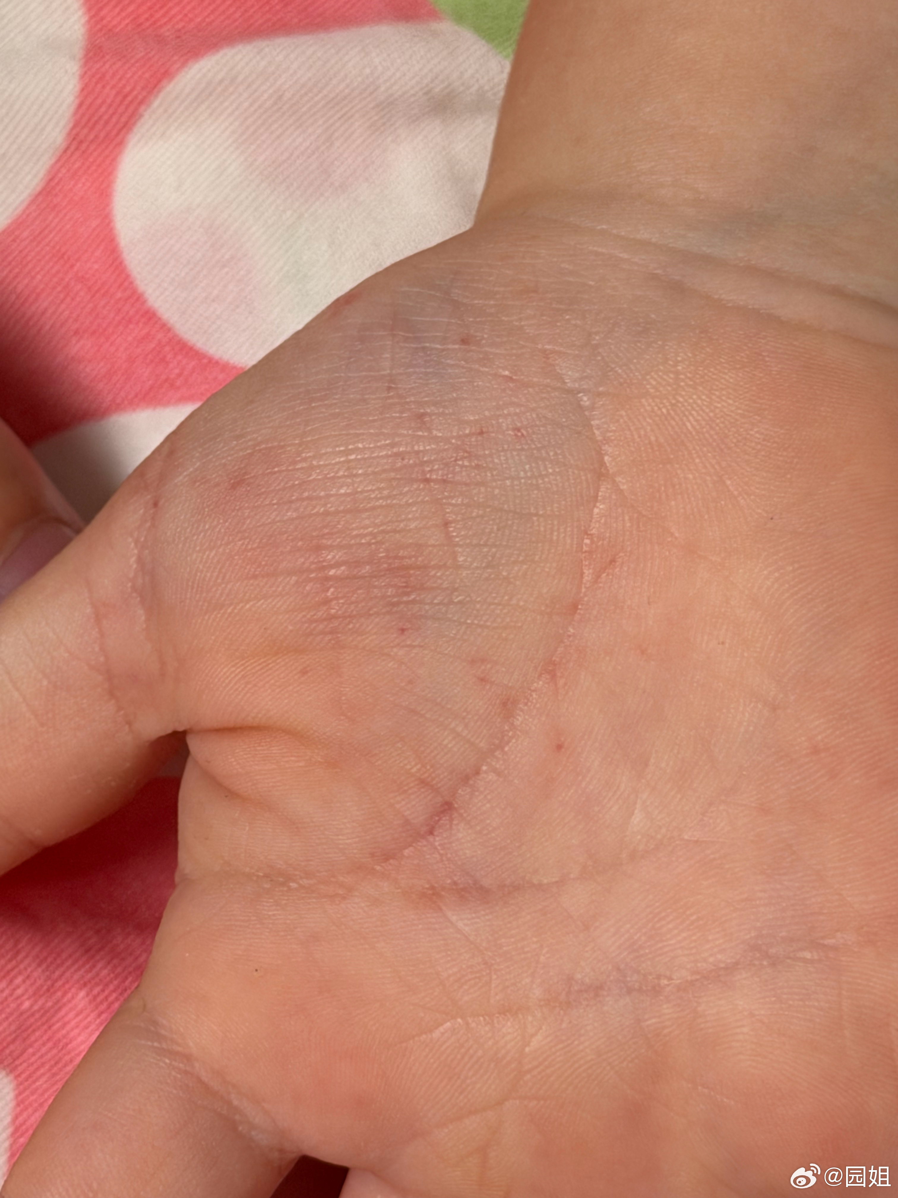 二宝手掌发现一些小红点，不会是手足口吧，口腔和其他部位没发现有问题