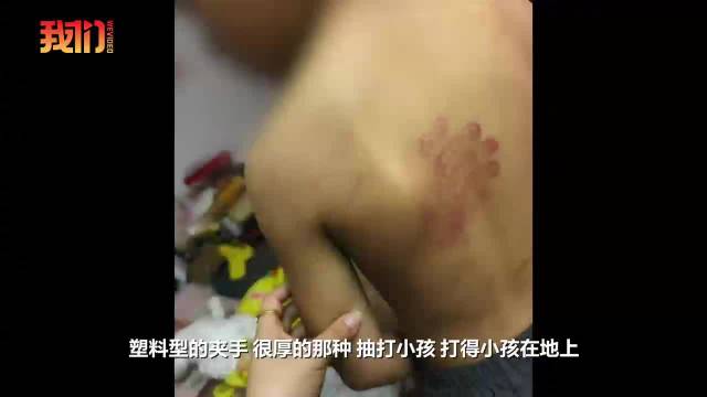 【#湖南9岁男童疑遭老师抽打全身伤紫#】#当地就男童被故意伤害一事立案调查#9月21日，湖南邵阳县何