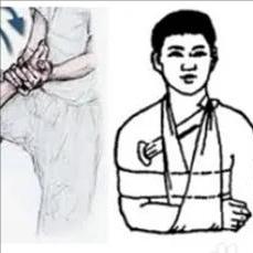 偏瘫后肩膀“掉下来”？小心肩关节半脱位！
 
很多偏瘫患者在病发之后会出现肩膀“