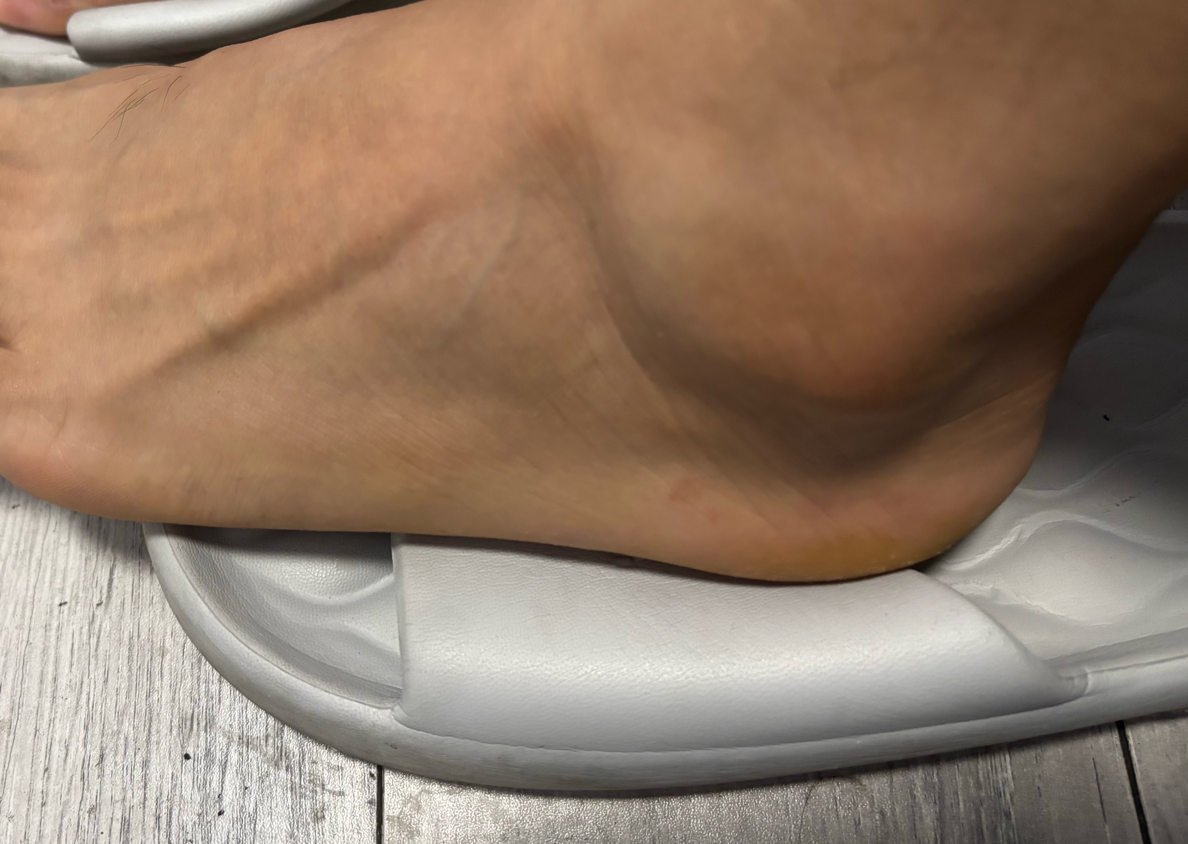 完蛋，脚肿了，走不了路了。