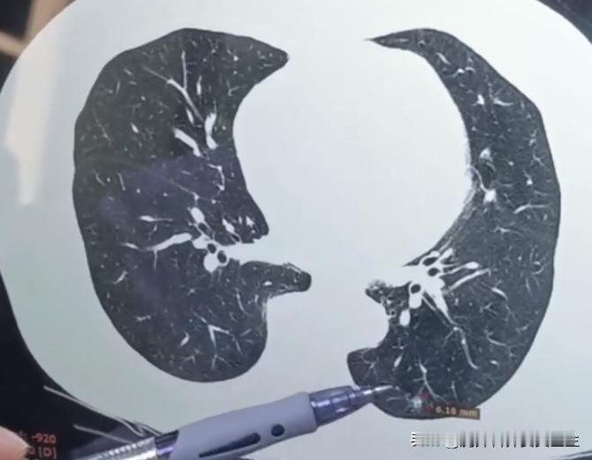 很多朋友做完手术后，发现肺里还有结节没切干净，又查出基因检测是阳性，就会想着能不