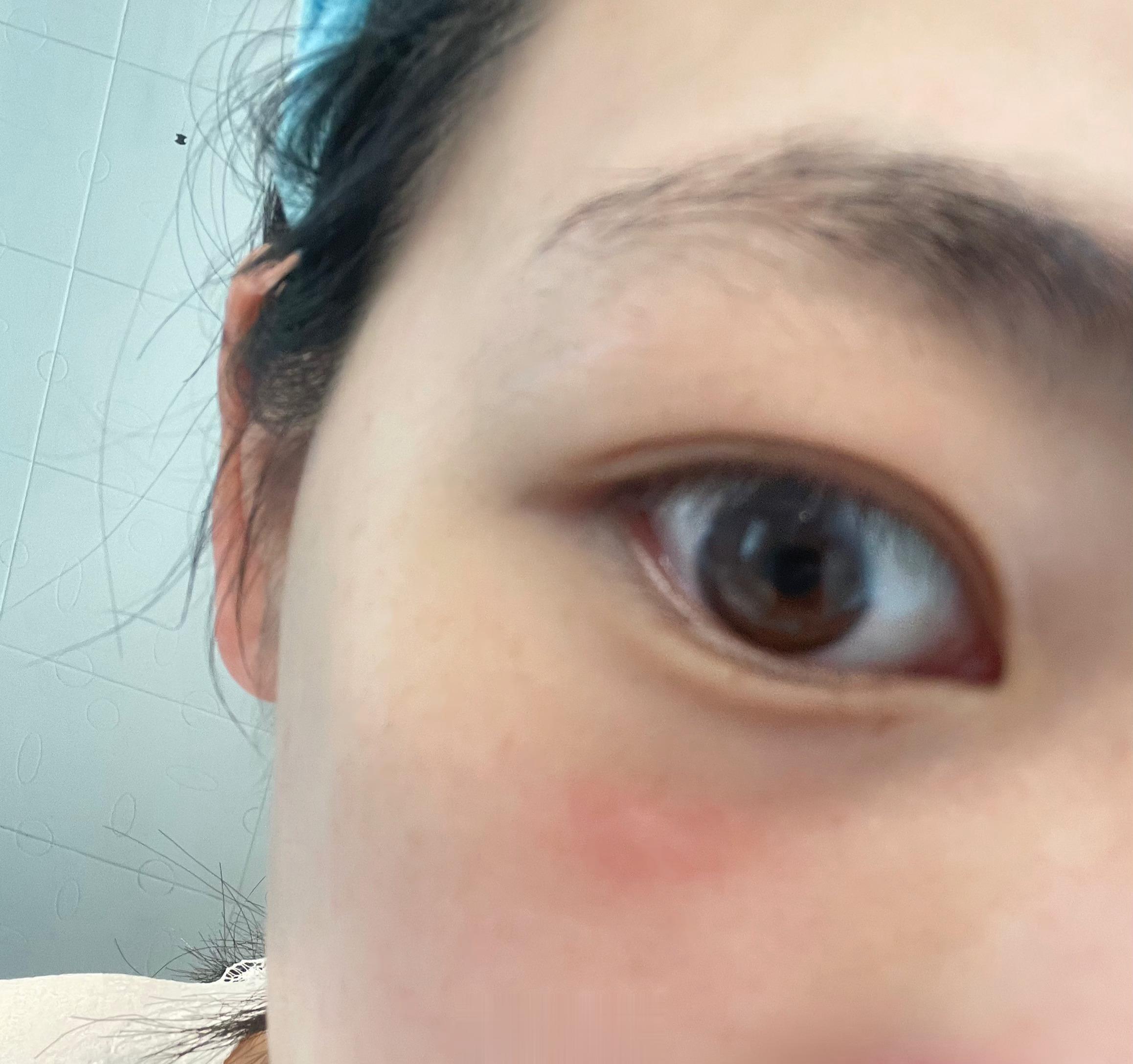 啊啊啊啊啊！那个蚊子🦟咬的！！站出来 我拍shi你[抓狂][抓狂][抓狂][抓