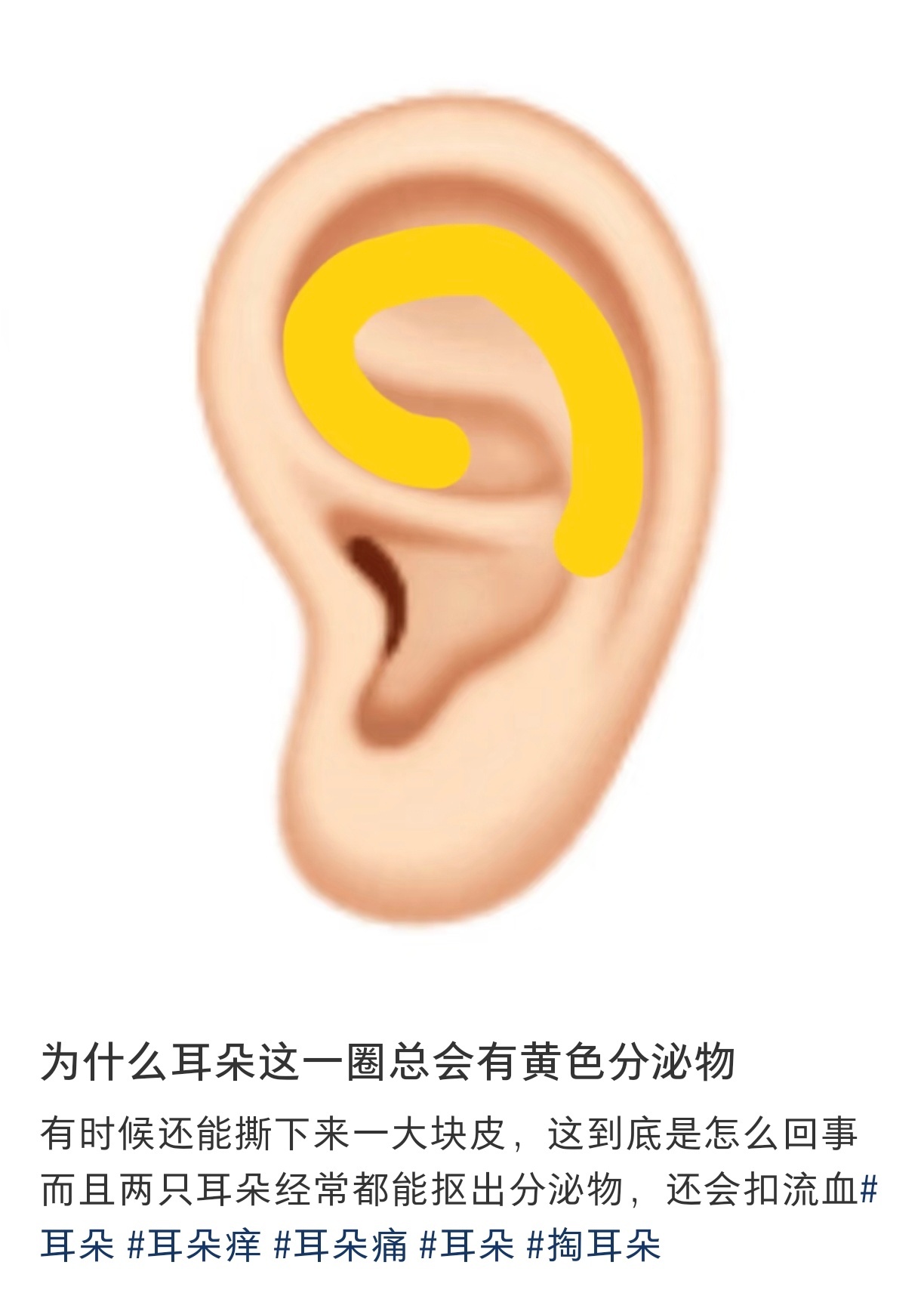 终于有人科普了耳朵这一圈的黄色分泌物 ​​​