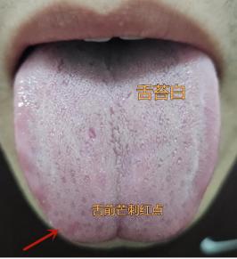 又是一个寒热夹杂的舌头，怕冷又怕热，明显寒多于热的舌头！
 
今天来门诊的这个患