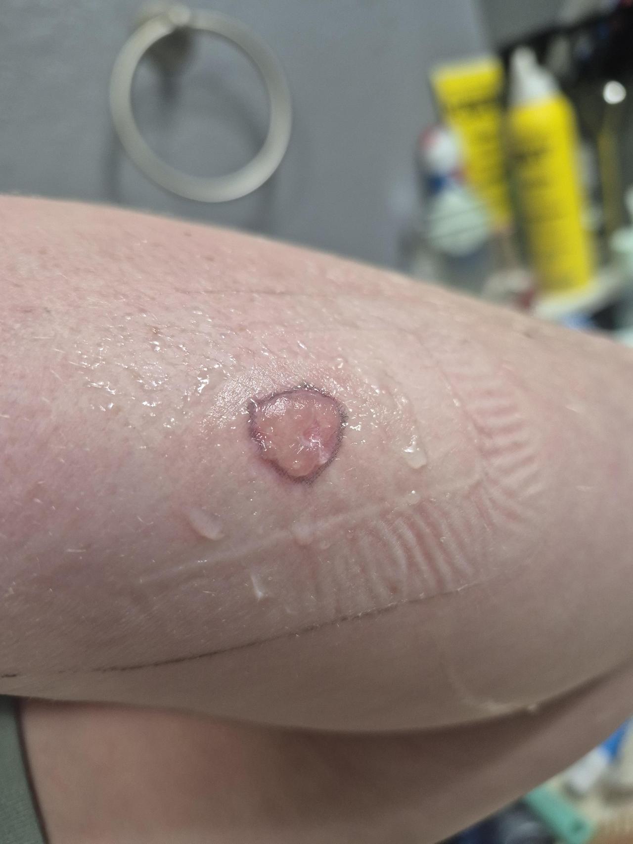 被黑寡妇蜘蛛咬伤3天后，伤口照片显示情况相对轻微，没有感染迹象。发帖网友使用了非