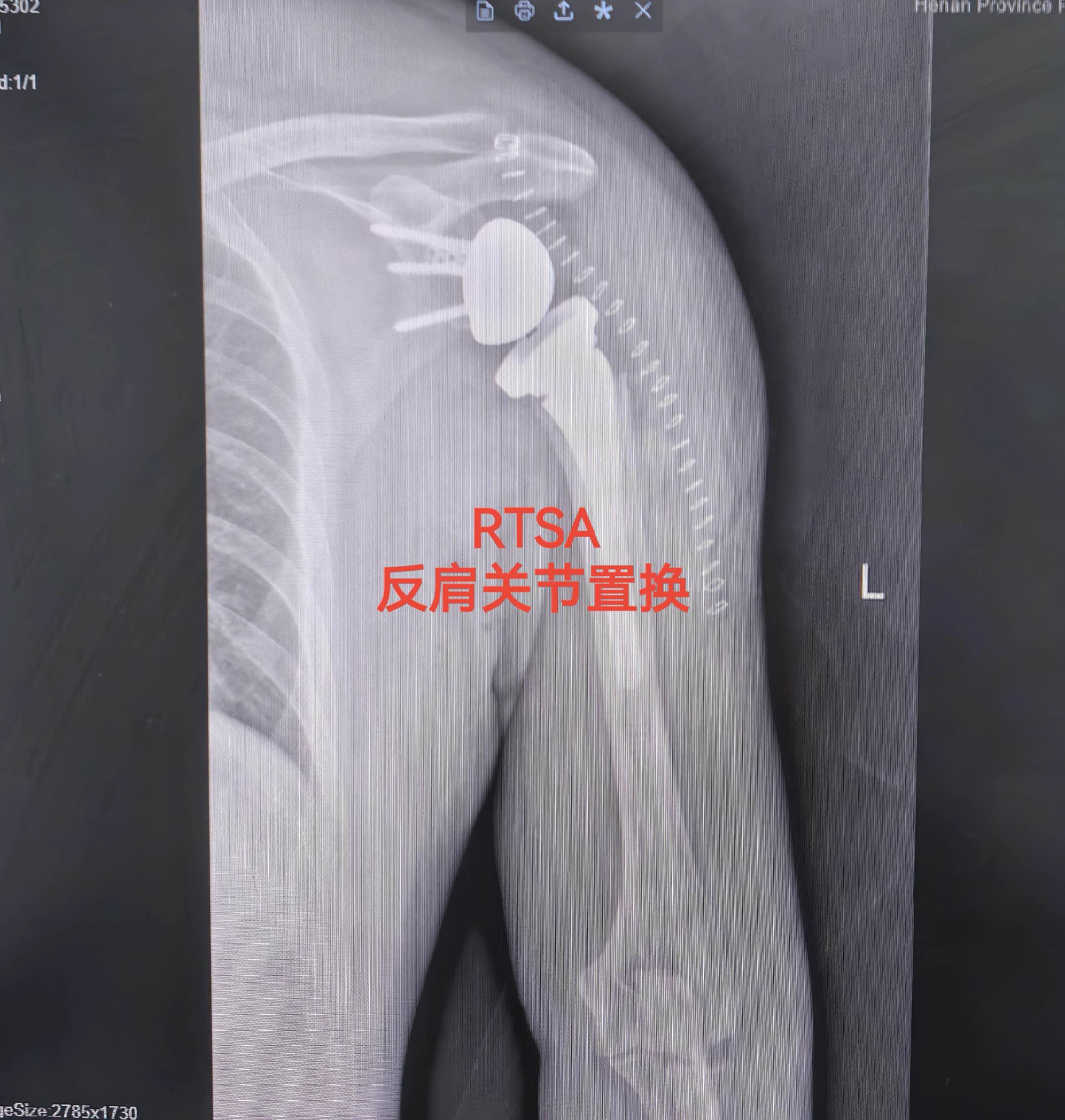 反肩关节置换。陈旧性肱骨近端粉碎骨折，RTSA完美解决。