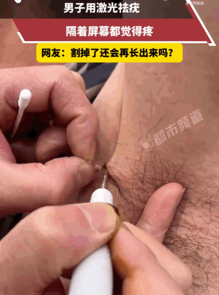 是个狠人！7月28日媒体发布，安徽，一男子因腋下长疣接受激光治疗。医生手持激光头