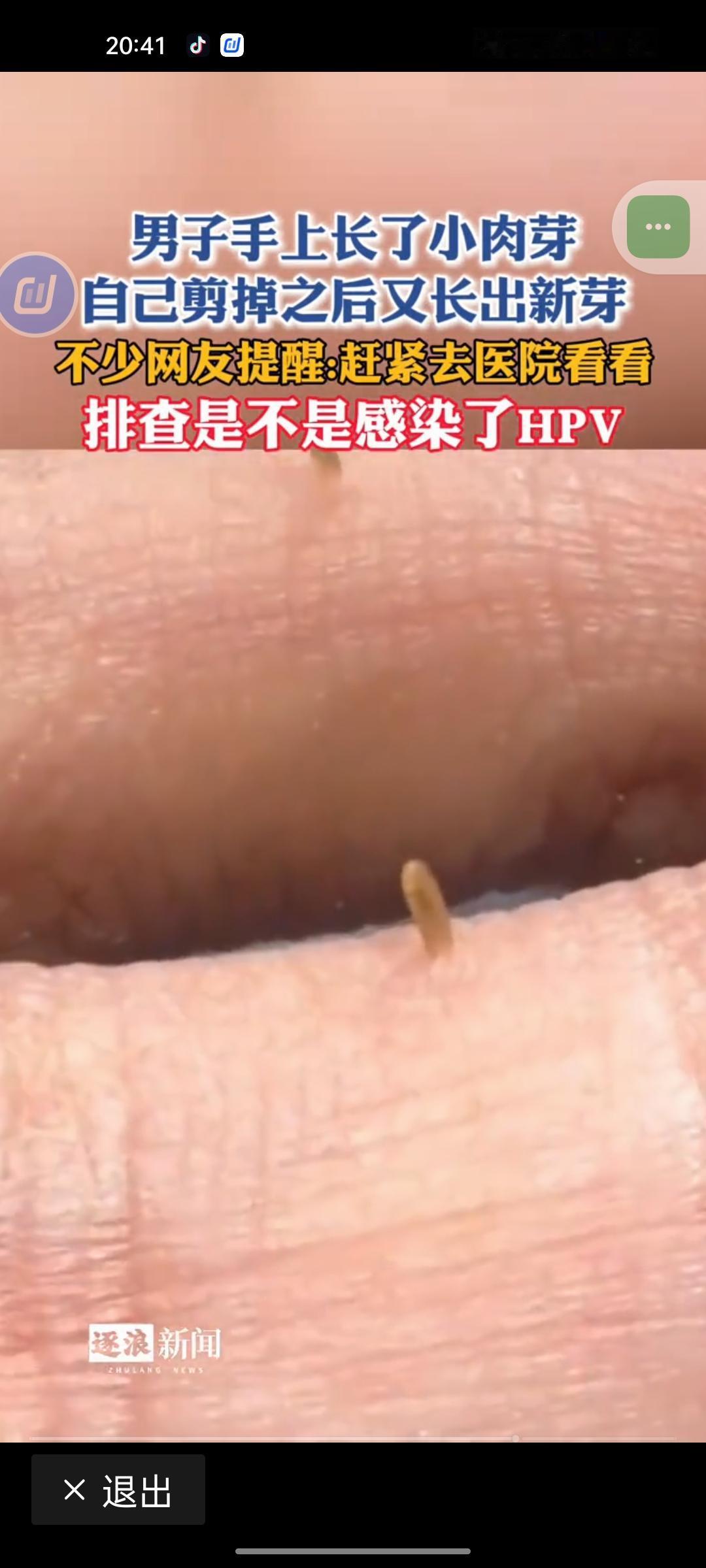 不少人看到手上冒个不痛不痒的小肉粒，第一反应都是“多大点事”。找把剪刀用酒精擦两