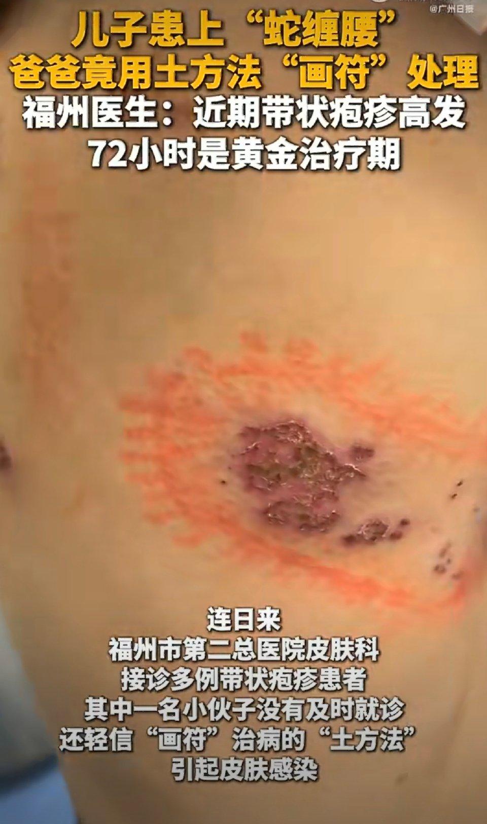 别拿生命赌偏方！儿子长蛇缠腰，父亲涂符水圈疱疹，差点酿成大祸
 
近日，一则让人