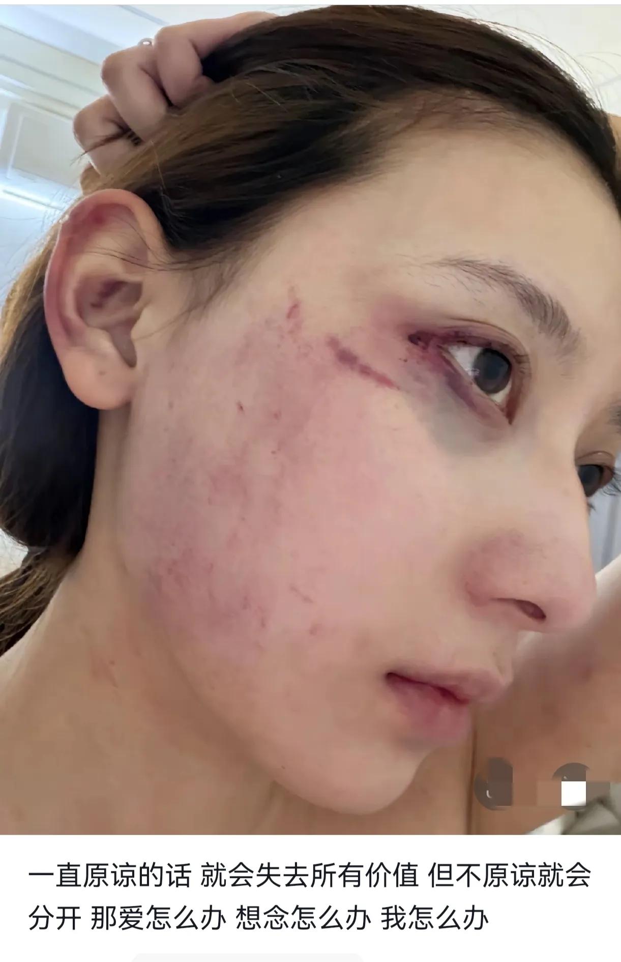 家暴只有零次跟无数次，成了这个模样，还在担心失去渣男，竟然还爱着想念着对方。
恋