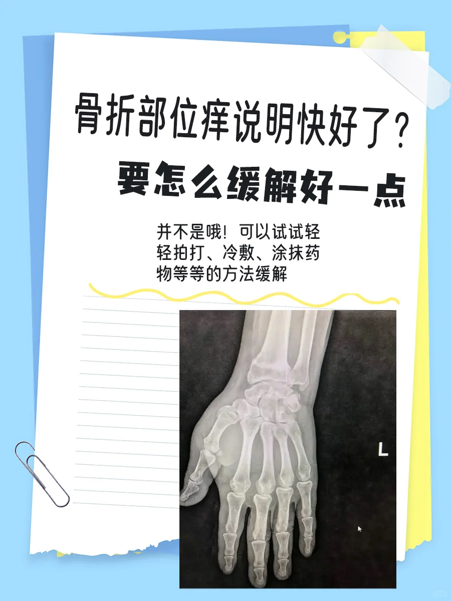 骨折部位痒说明快好了