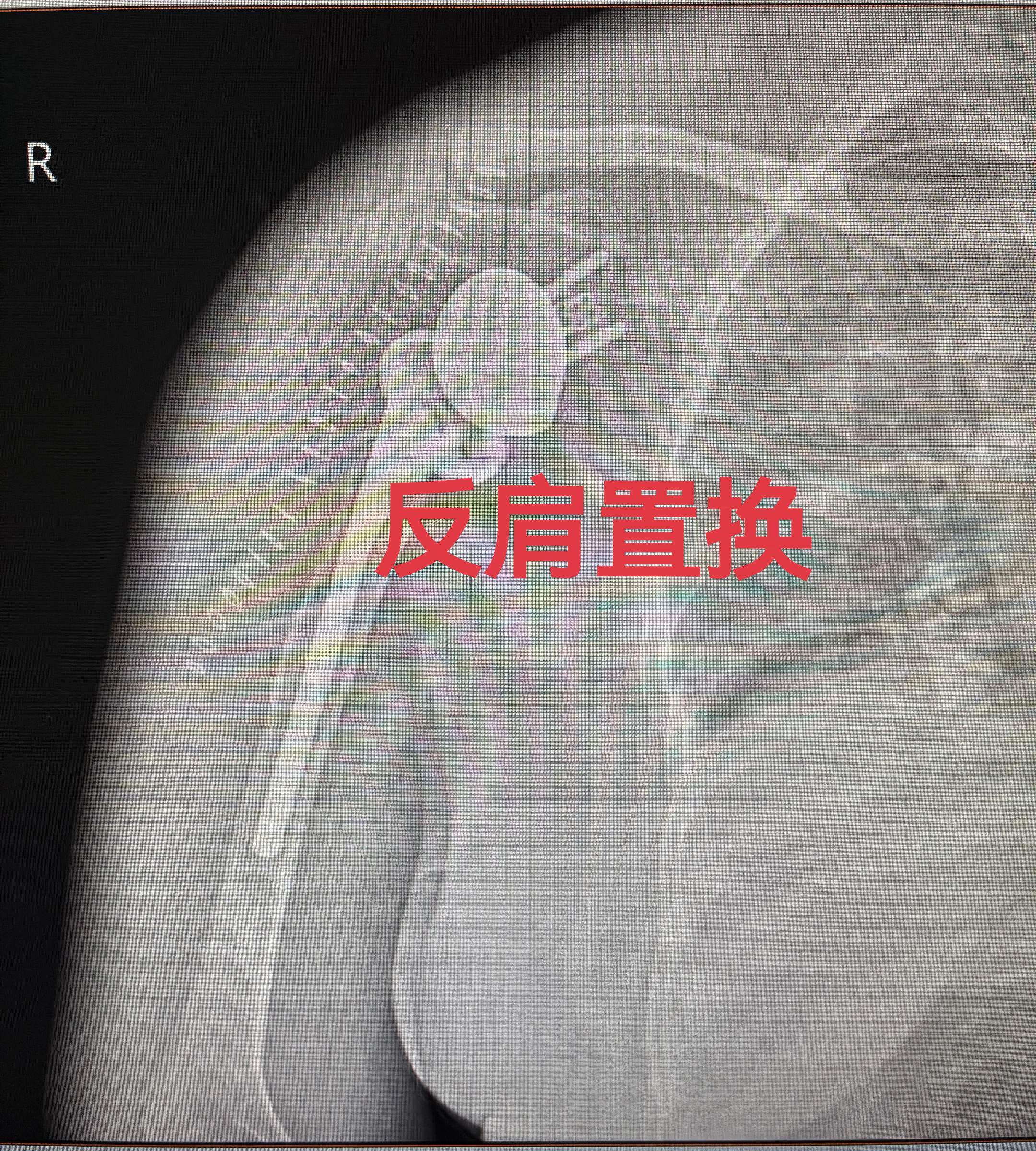 反肩置换。反置式全肩关节置换术（RTSA），拯救不可修复性肩关节病损的...