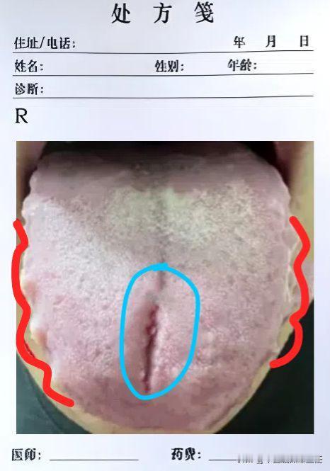 提醒大家一句，碰到这种齿痕舌，再去吃参苓白术散已经没用了，该换换调理方式了！
