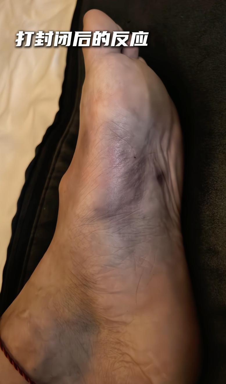 孙总真硬汉！孙铭徽分享打封闭治疗过程，咬牙切齿非常痛苦，脚底淤黑全是淤血。

看