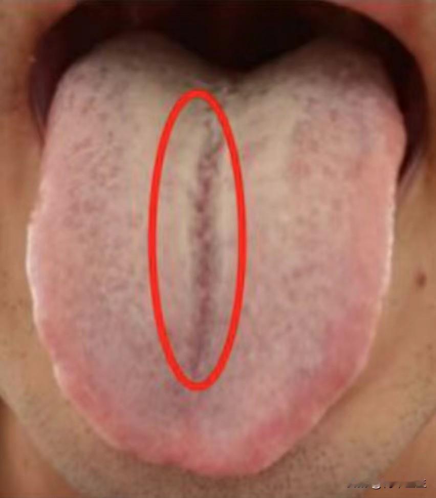 舌中有裂纹，别傻傻的只会健脾，这样的情况很复杂，单纯健脾没效果
其实这样的舌象很