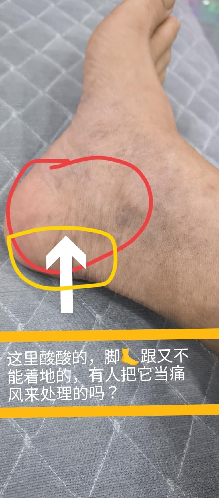 有没有人，把脚🦶跟的酸酸软软，脚跟着不到地的这病，都认为是痛风发作，血液不循环
