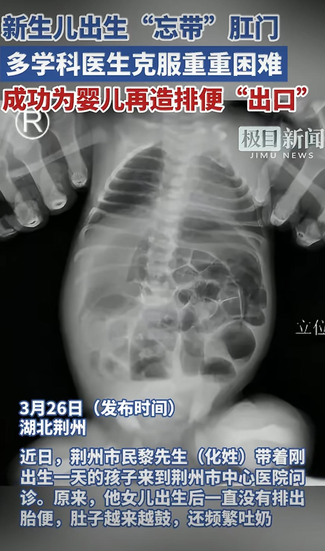 女婴出生一天无肛门，医院紧急手术成功救治
 
湖北荆州一对夫妻，抱着刚出生没多久