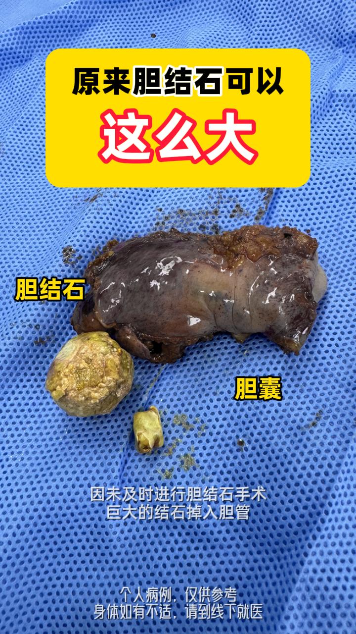 胆结石如果达到了手术指征，还是要尽快进行手术，如果石头掉入胆管，你看那么大的石头，会有多疼，手术还做了足足两个小时才把石头取出来，受罪的是自己啊。