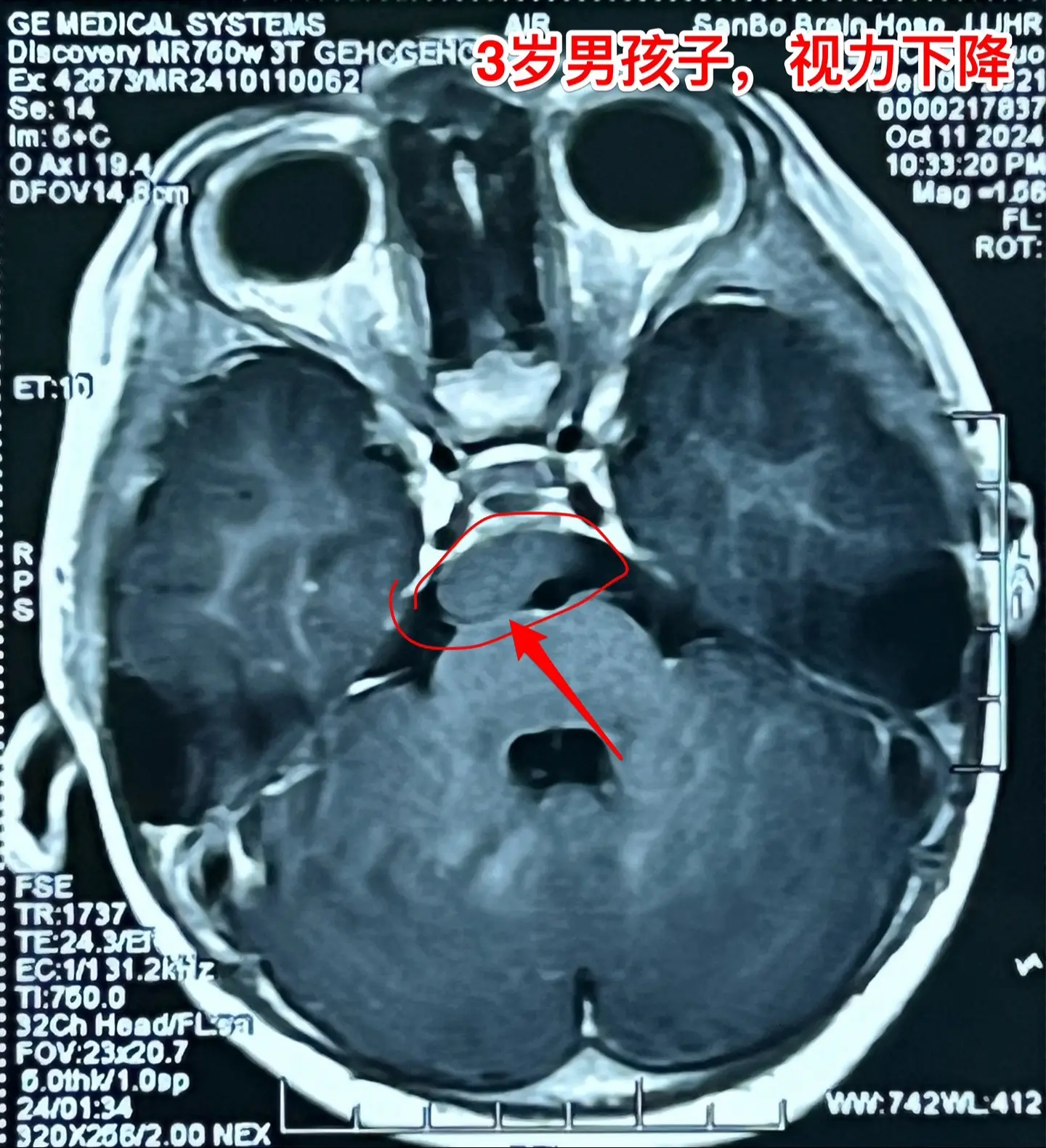 鞍区高密度囊肿-高密度不等于钙化。拉克氏囊肿在CT扫描中大多数呈低密度...