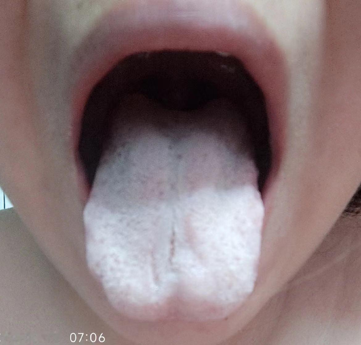 不是光我说白，你自己看看舌头白不白！气血亏虚太久了
那么这类病人典型表现，身体像