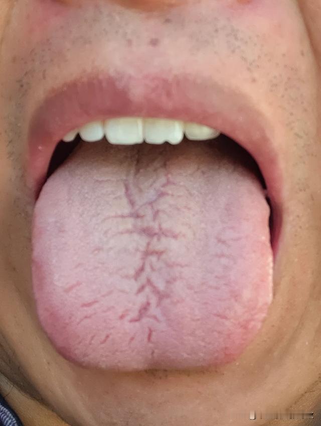 舌面被分割的乱七八糟的，真的像个蜘蛛网[捂脸][捂脸][捂脸]
吃了几个月药了，