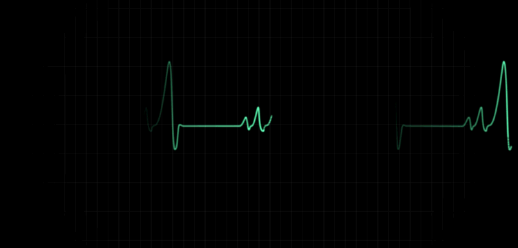 【#身体有这6种表现最好别运动#】运动猝死看似事发突然，实则有迹可循。如果近期存