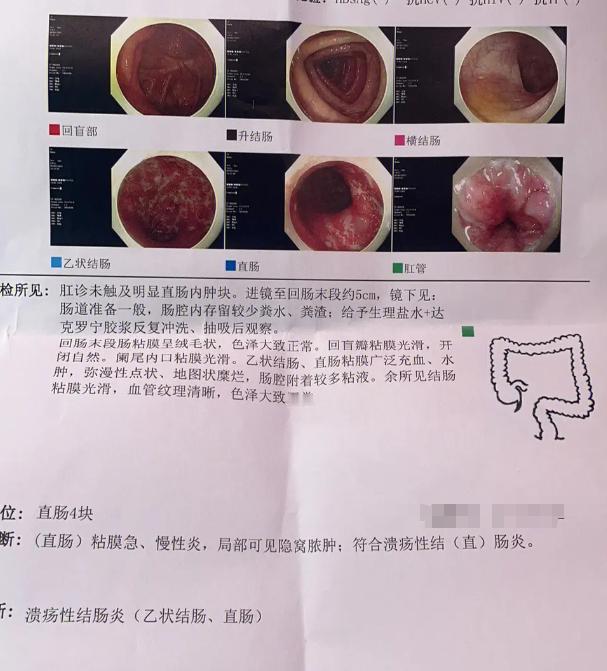 溃疡性结肠炎，腹泻脓血便6个月，中医用1个月恢复正常
患者间断性腹泻、黏液脓血便