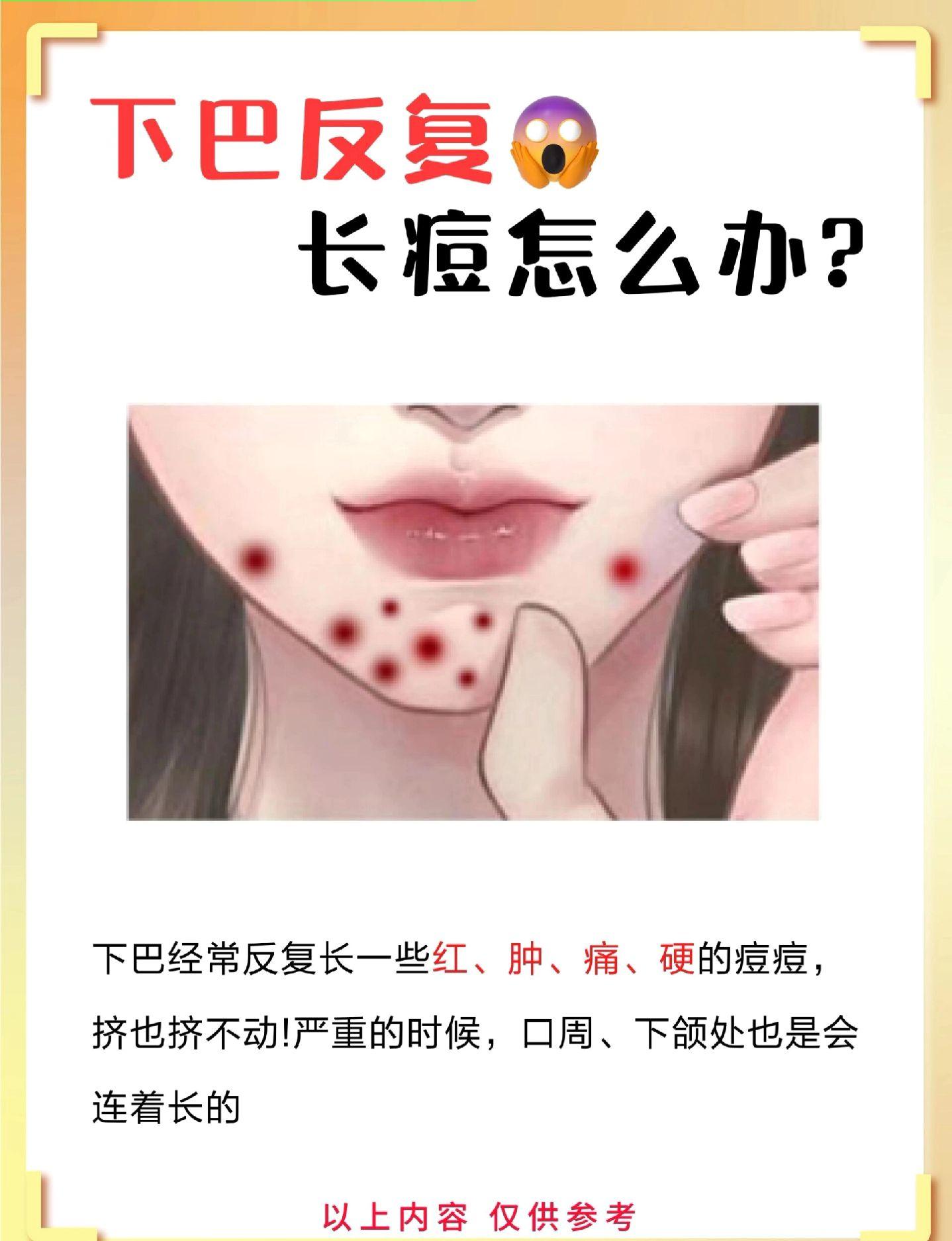 下巴为什么反复长痘?进来了解原因。下巴痘痘反复长痘痘远离我