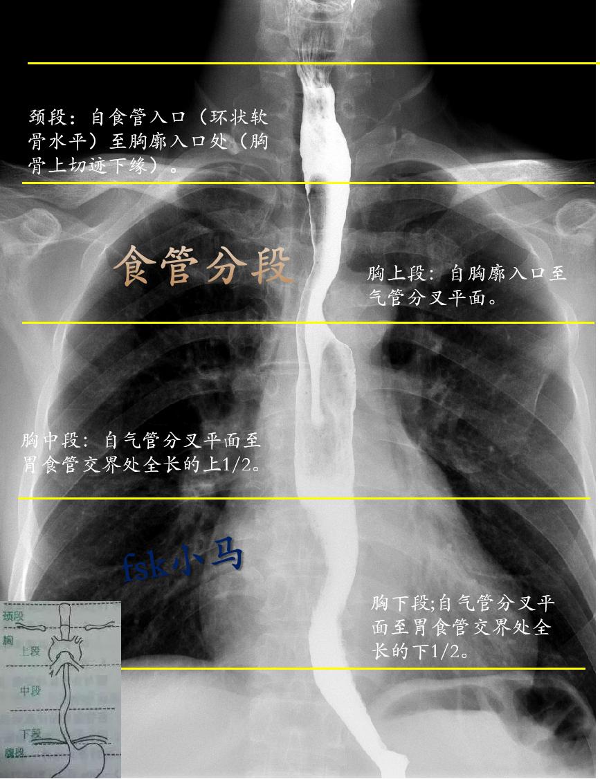 食管分颈段、胸段和腹段，胸段又分上、中、下三段。颈段：自食管入口（环状...