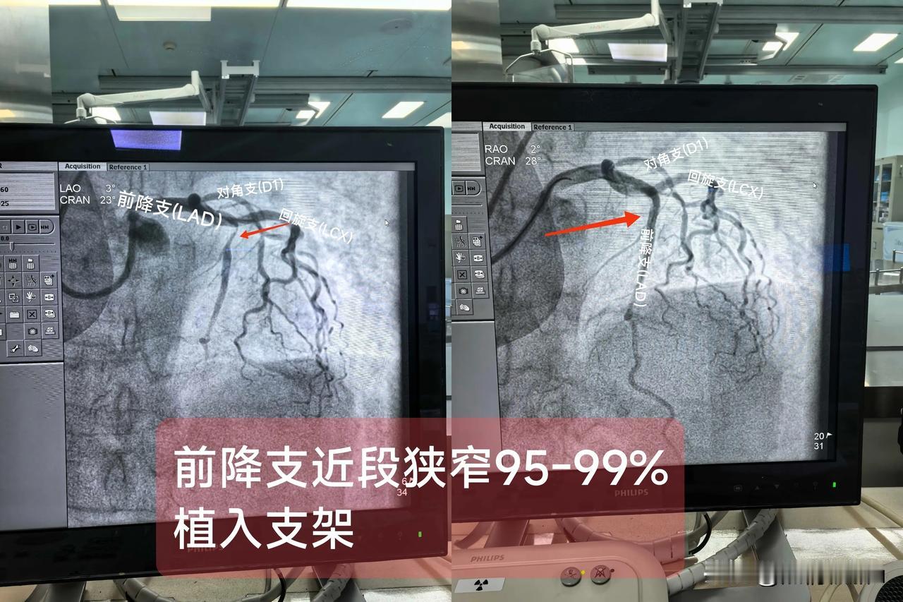 急性ST段抬高型心肌梗死
（前降支近段狭窄90∽95）
一.概念：
前降支主要为