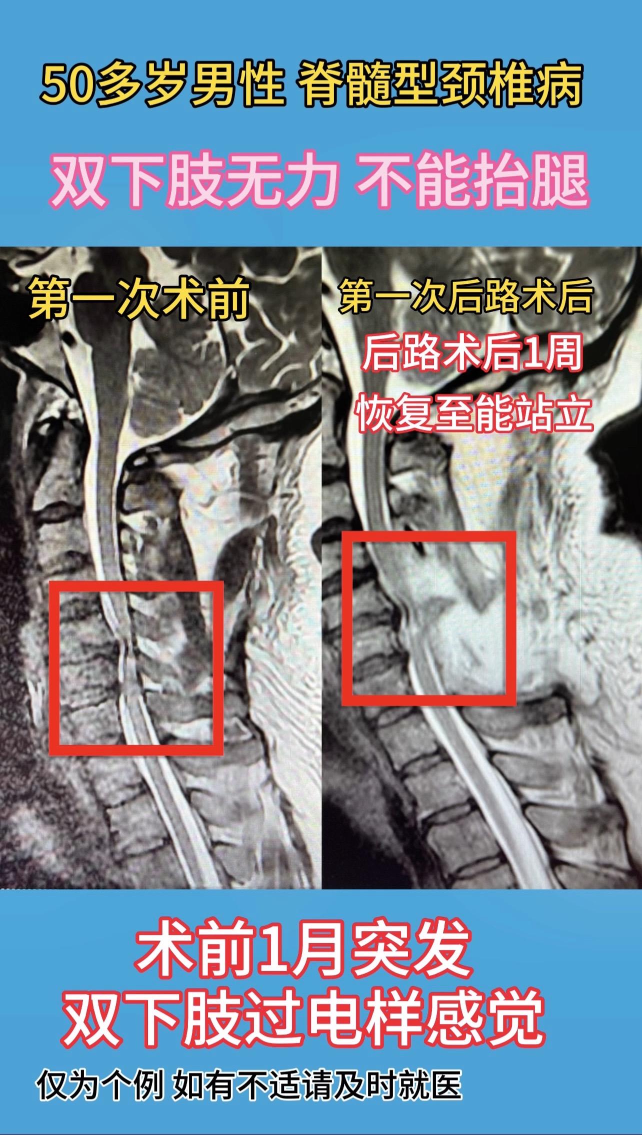 50多岁男性，脊髓型颈椎病，1月前突发双下肢过电样感觉，休息后好转，当...
