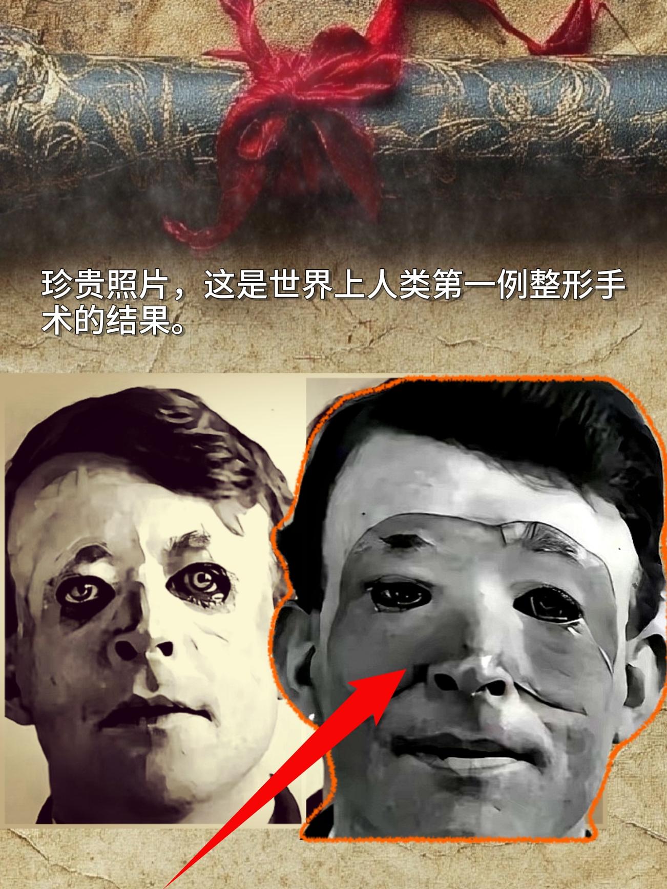 珍贵照片，这是世界上人类第一例整形手术的结果。