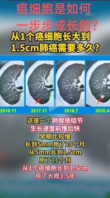 癌细胞是如何一步一步长大的？ ​​​一般而言，癌细胞刚开始发展比较缓慢，后期会爆