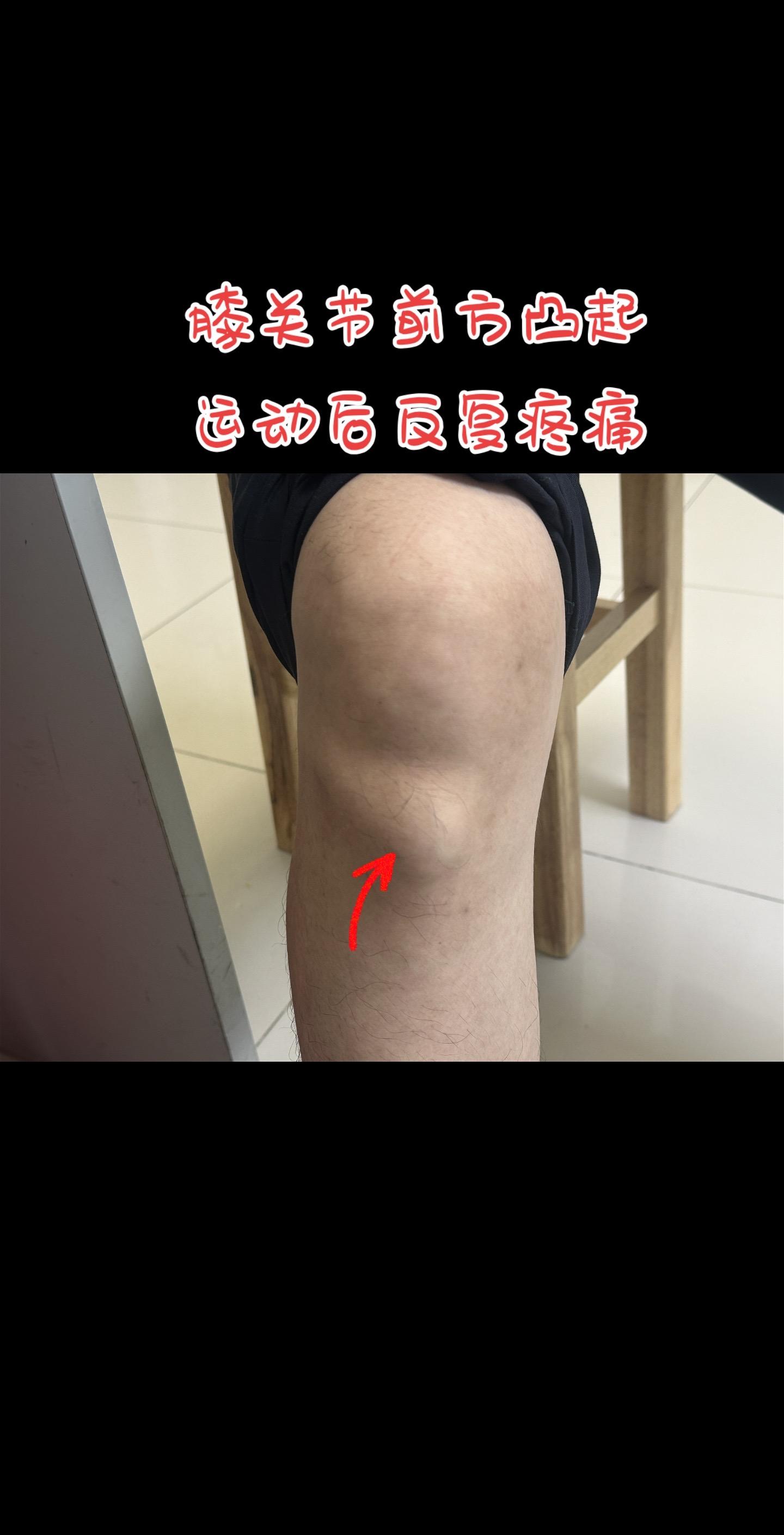 运动后膝关节痛什么问题。这个膝关节痛有点意思