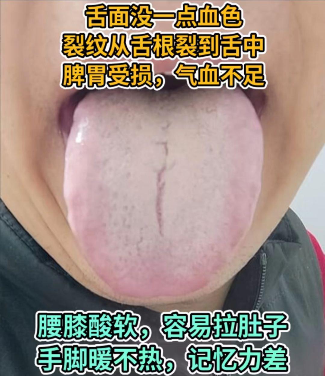 舌苔分析：肝郁 脾虚 看看舌头就知道