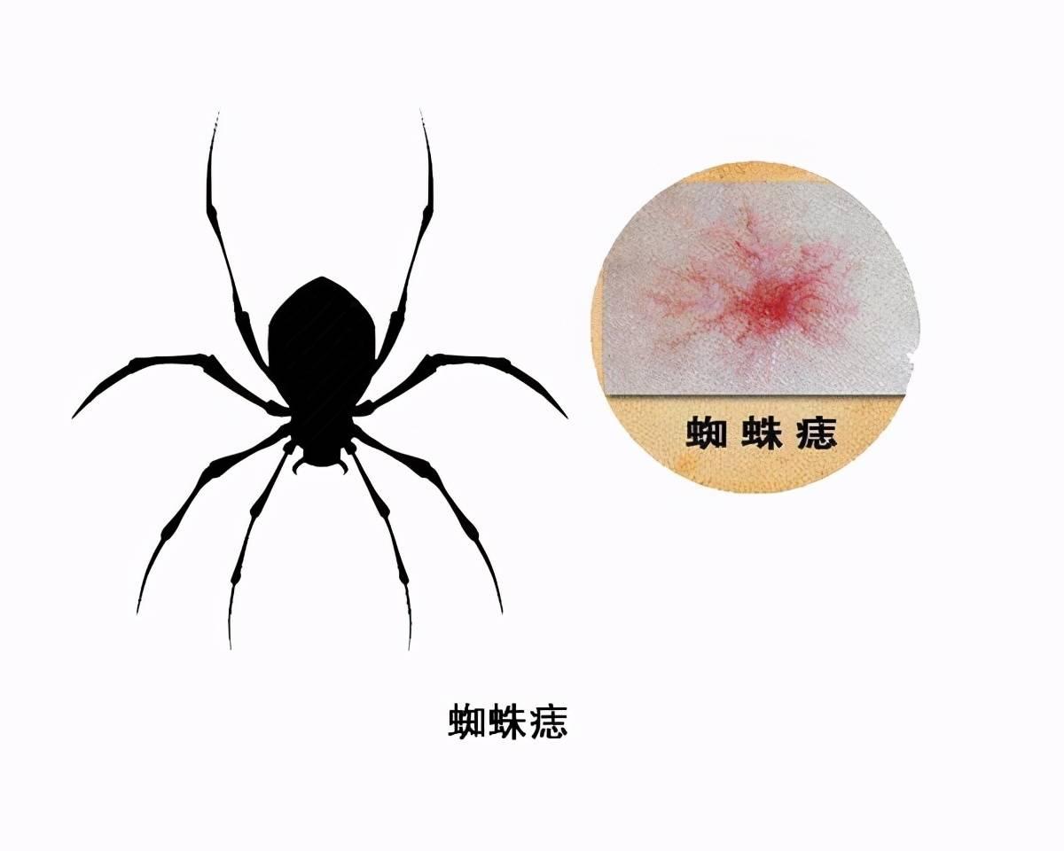 蜘蛛痣一定是跟肝有关系吗

蜘蛛痣不一定是跟肝有关系，主要与雌激素水平增高相关，