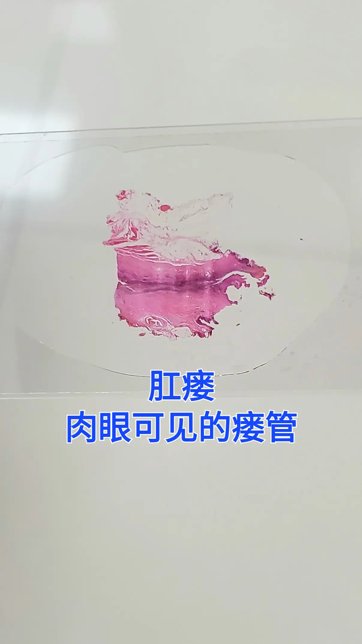 肛瘘