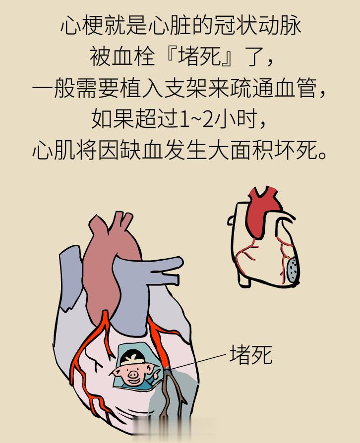 #心梗黄金2小时有多重要##世界心脏日#急性心梗是一种严重的心血管疾病，且趋于年