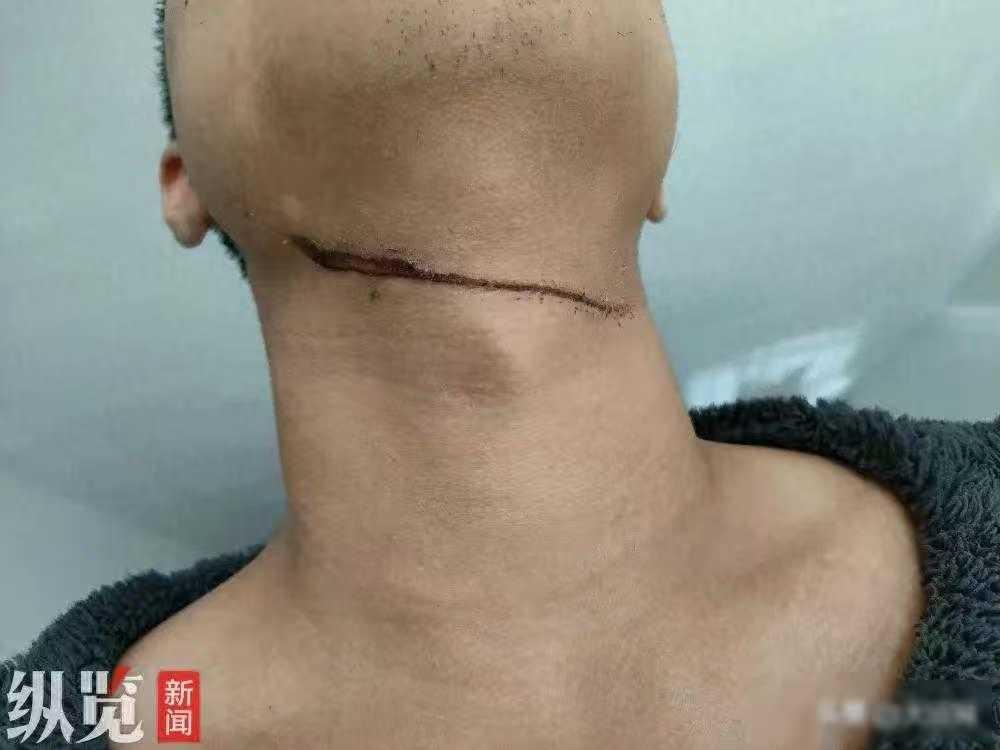 小丁夜骑被绳割喉勒伤，物业称难管，绳子是谁绑的？
11月25日晚上6点40分，在