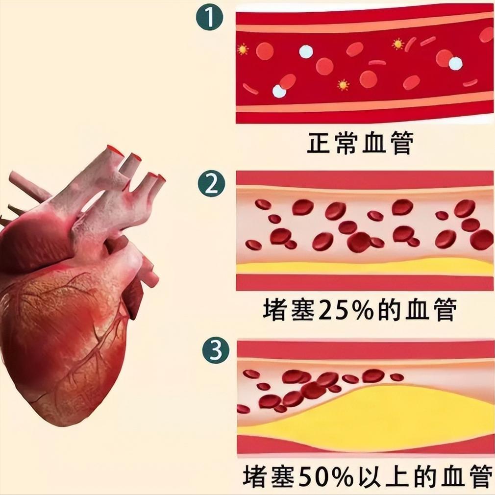 血管“堵车”八大原因，看看你中了几条？
血管就像我们身体的“高速公路”，一旦堵塞