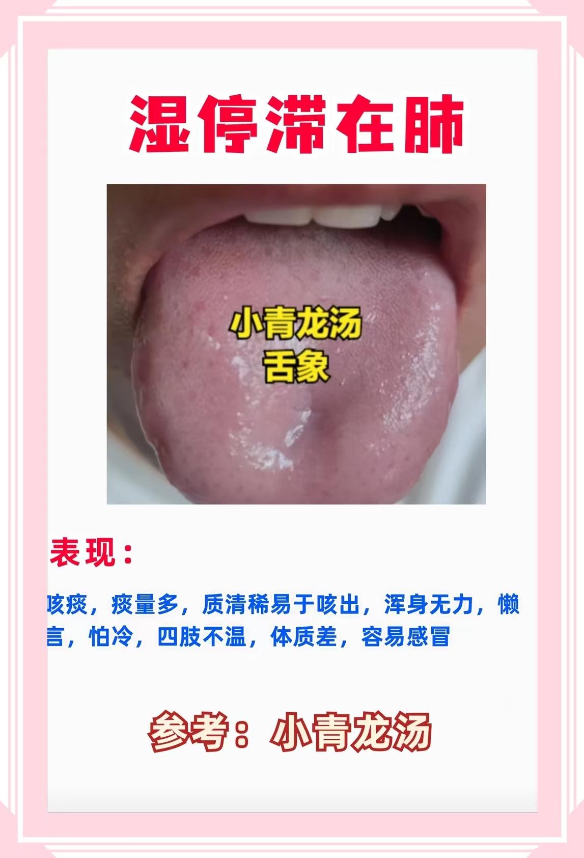 “湿在肺” 的舌象和症状观察很敏锐！但要注意核心误区：小青龙汤的核心适配是 “寒