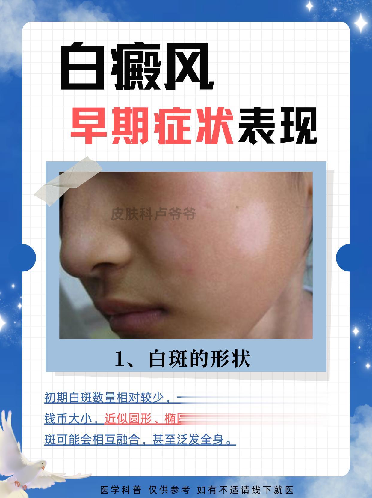 白斑就是白癜风？大家对应查看就行！
