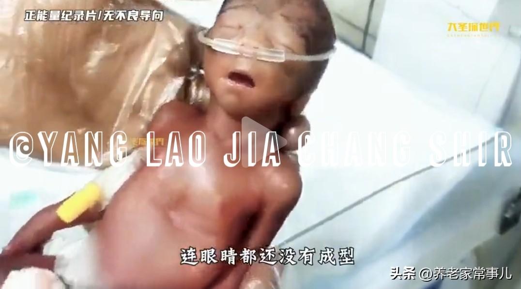 600克“掌心宝宝”出院！医生双手捧着救回一条命，这是奇迹的重量！
 
刚出生时