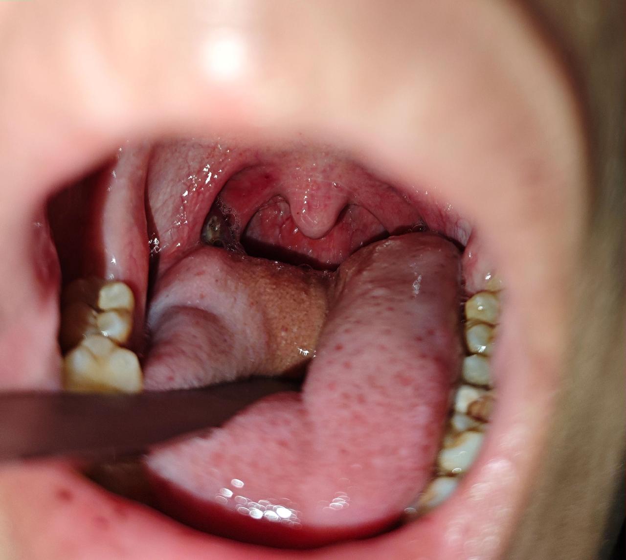 咽痛痰中带血丝今天门诊遇到一个18岁大一的男生，长得高高帅帅，患者的主诉就是右侧