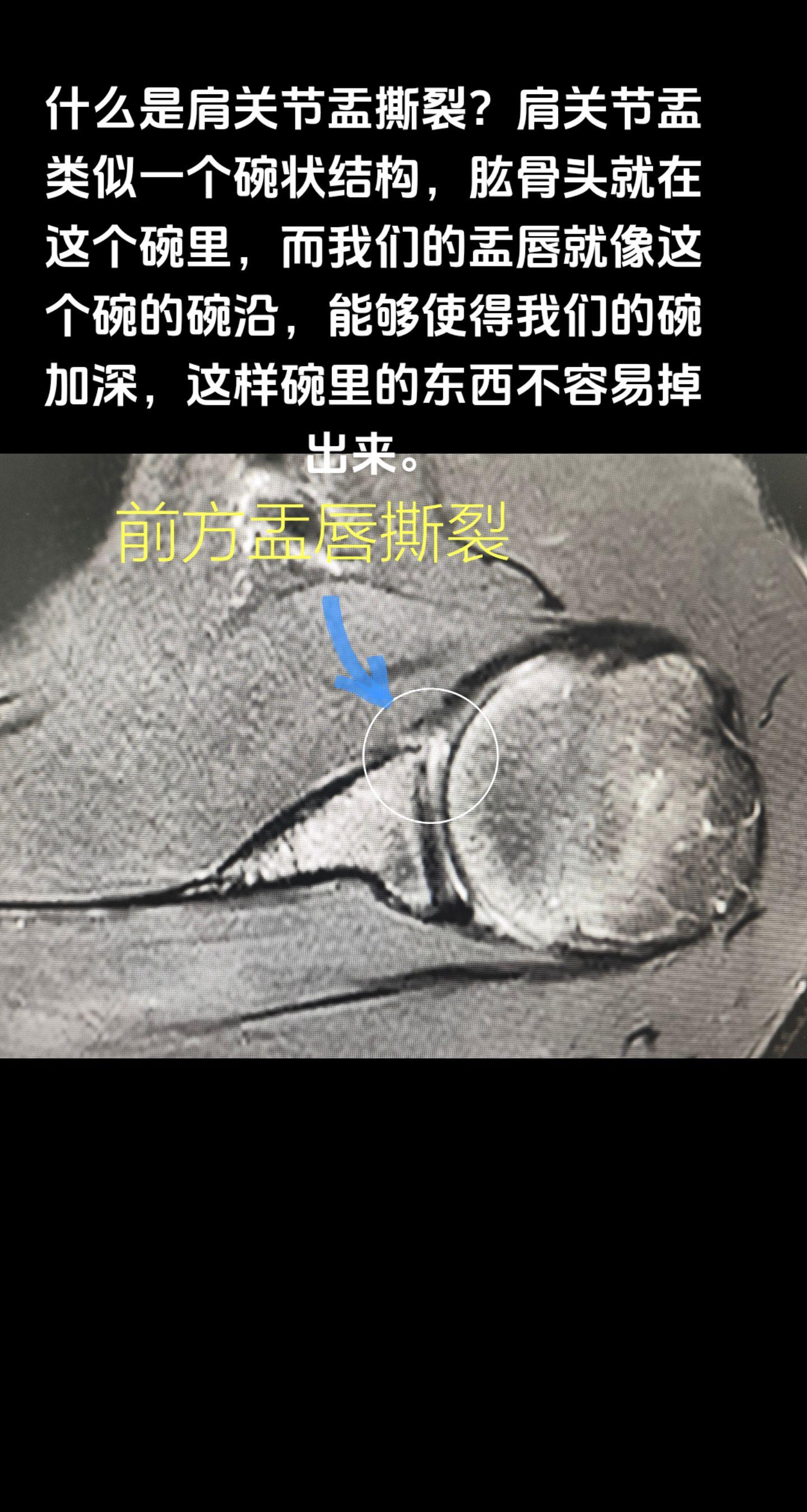 什么肩关节盂唇撕裂？