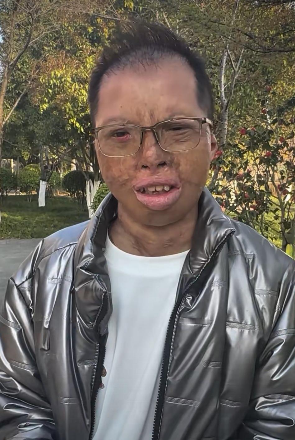 救人烧伤，被救者却从未联系致谢。胡亚武冲入火场救出三人，自己却严重烧伤。令人唏嘘