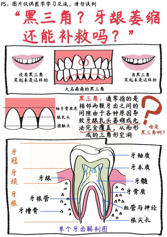 📒笔记｜黑三角？牙龈萎缩还能补救吗？